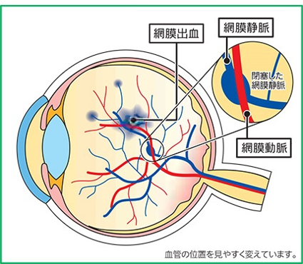 網膜静脈閉塞症
