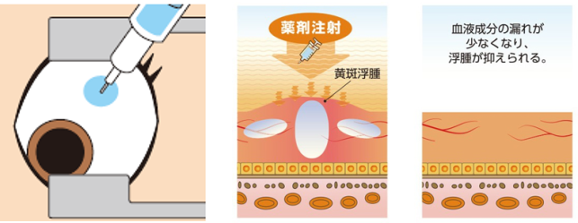 抗VEGF薬硝子体内注射
