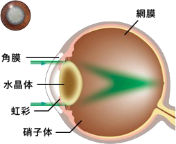 白内障の説明