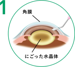白内障手術 手順1