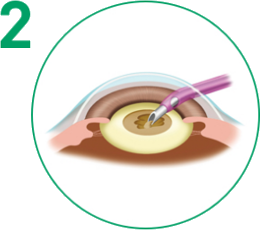 白内障手術 手順2