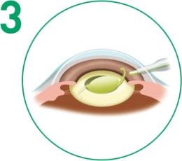 白内障手術 手順3