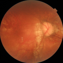 強度近視(変性近視)の眼底