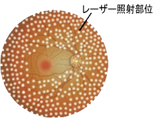 糖尿病網膜症・網膜静脈閉塞症