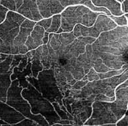 OCTアンギオグラフィで得られた眼底の血管画像