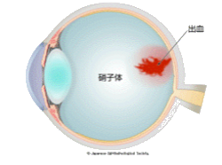 硝子体出血