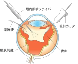 網膜硝子体手術